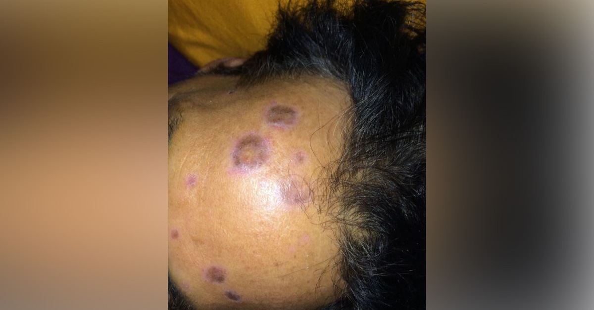 Diagnose The Immunocompetent Lesion