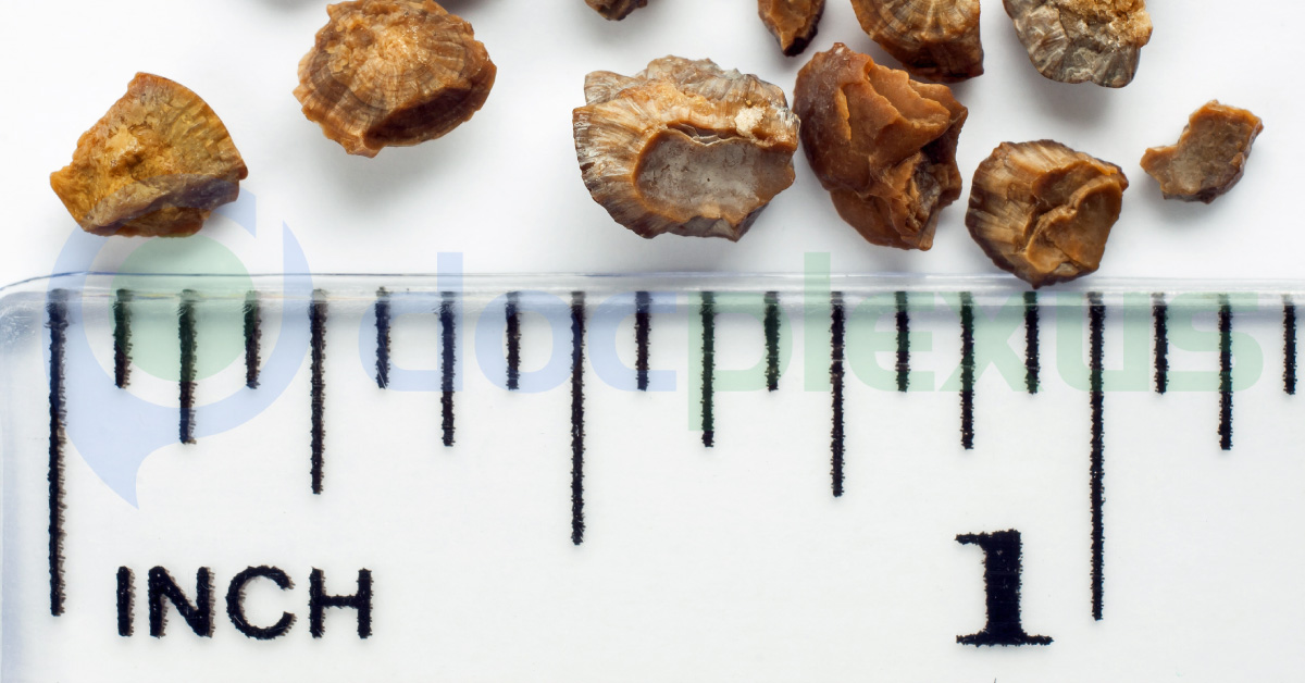 Tamsulosin, Alpha 1 Blockers Expulse Lower Uretic Stone And Pain Effectively