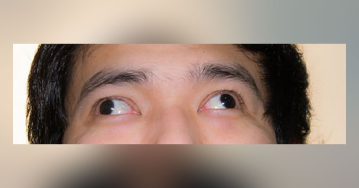 Brief Review On Ocular Manifestations Of Mental Retardation