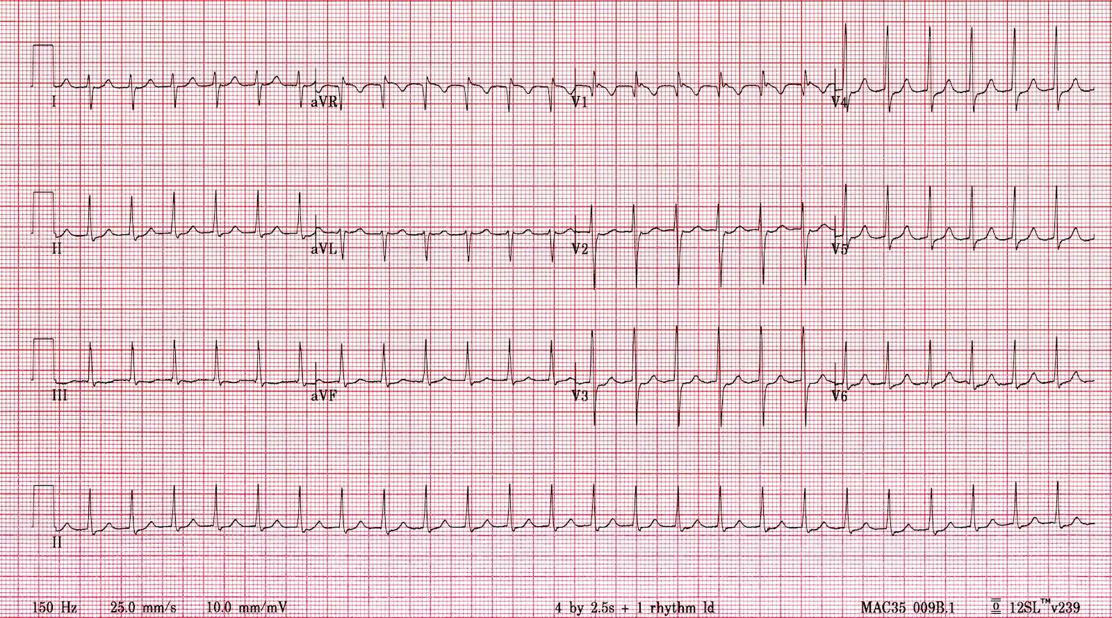 Interpret This ECG