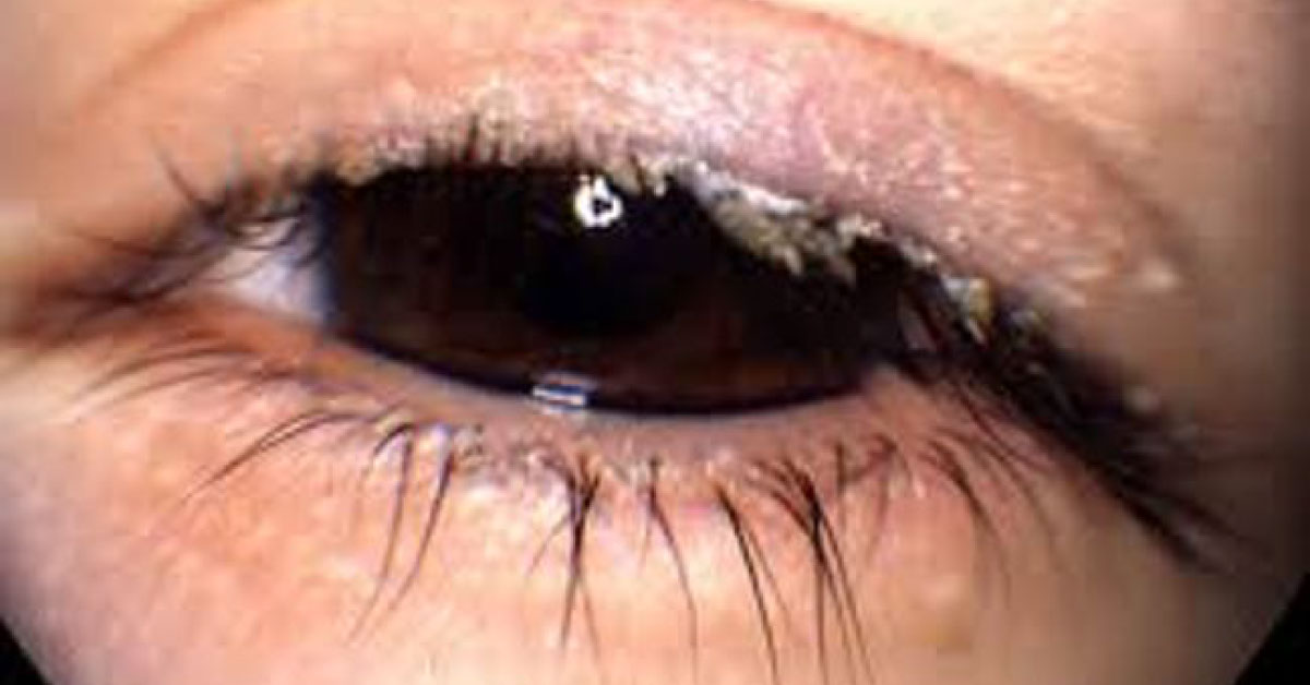 Brief Review On Ocular Manifestations Of Acne Rosacea