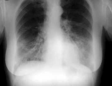 Inferior Lateral Wall MI In Elderly Patient
