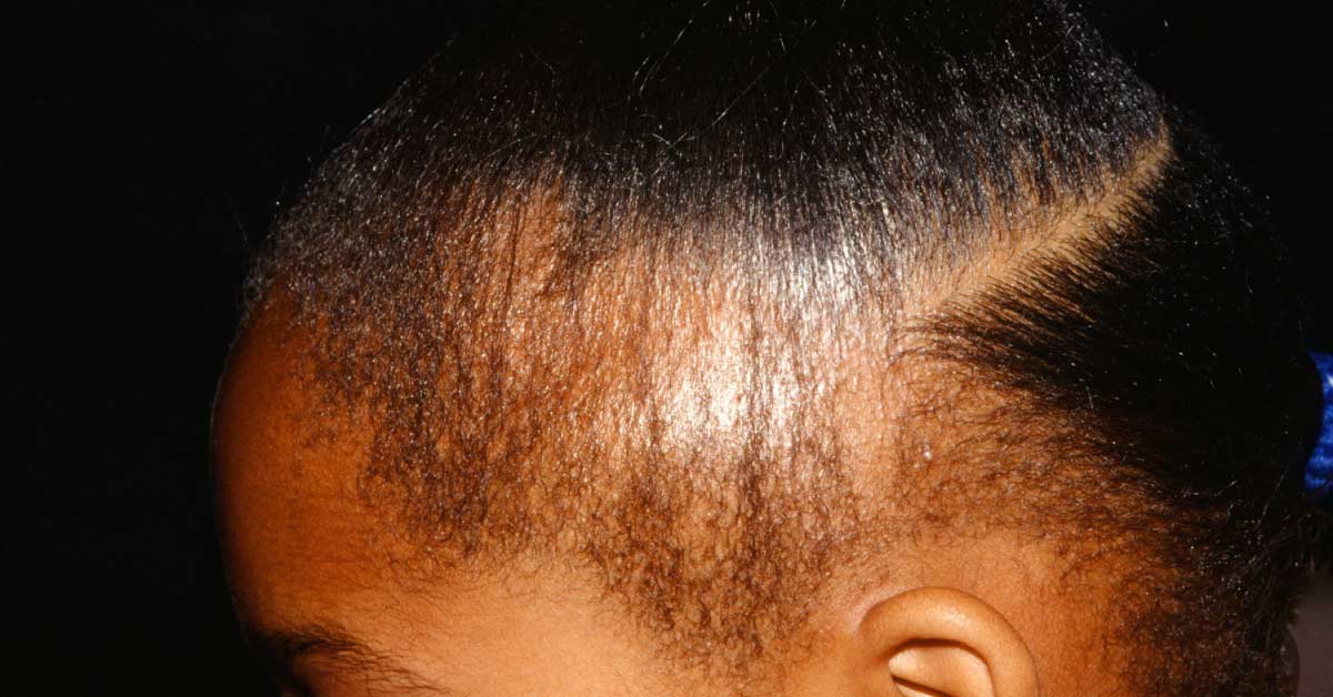 10 Year Old Getting Bald