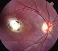 Brief Review Of Ocular Manifestations Of Toxocariasis