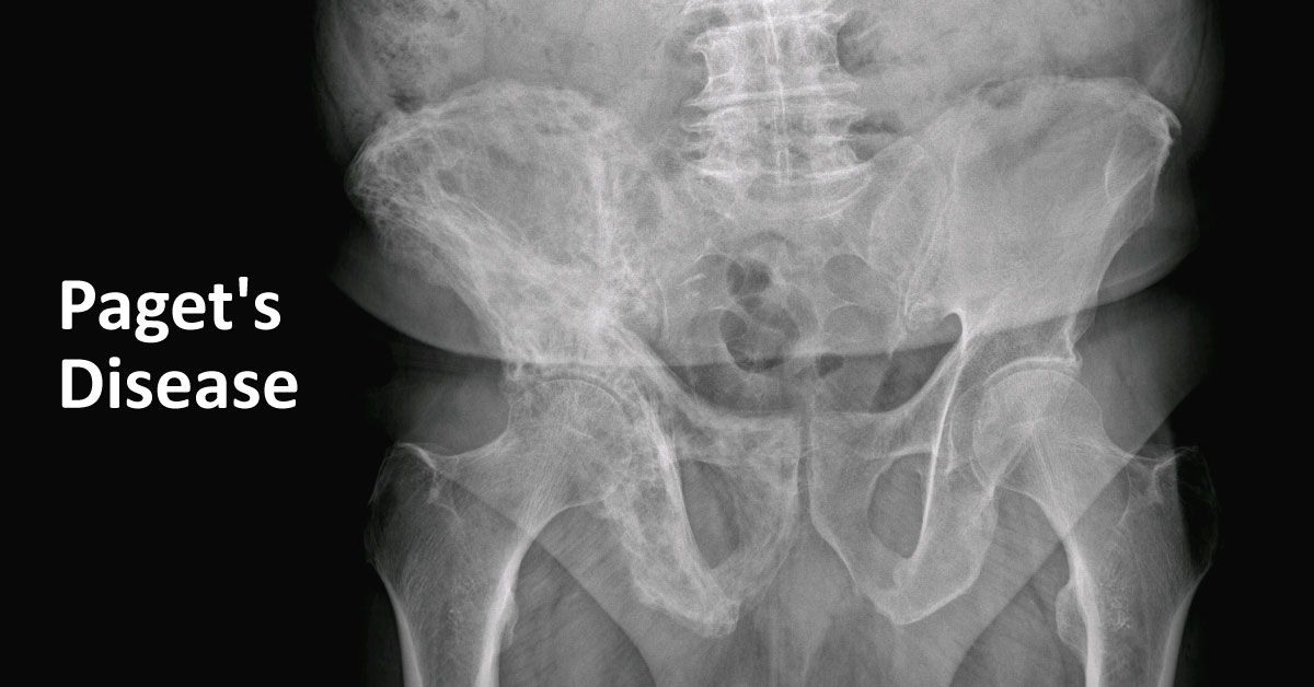 Paget’s Disease of Bone: A Clinical Guide