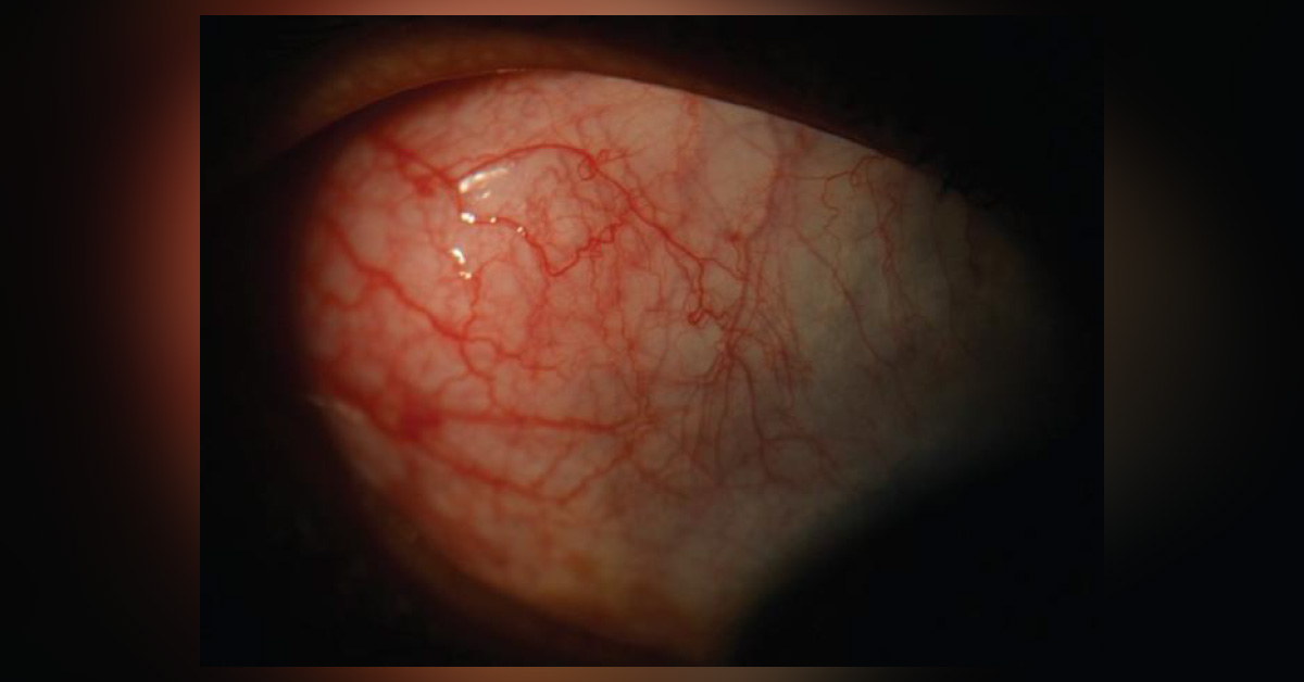 Ocular Manifestations Of Hypercalcaemia