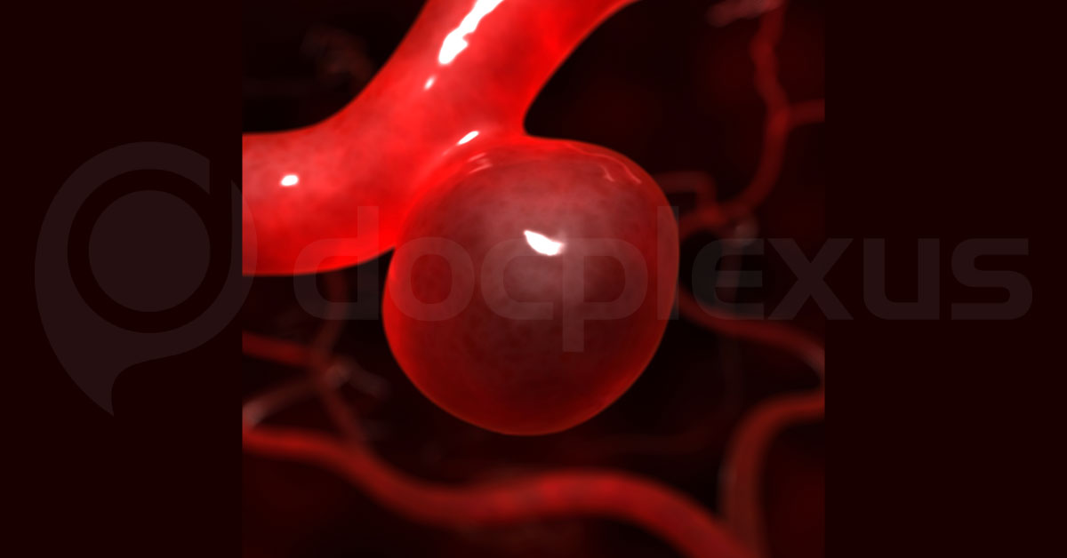 Left Ventricular Pseudoaneurysm After Myocardial Infarction