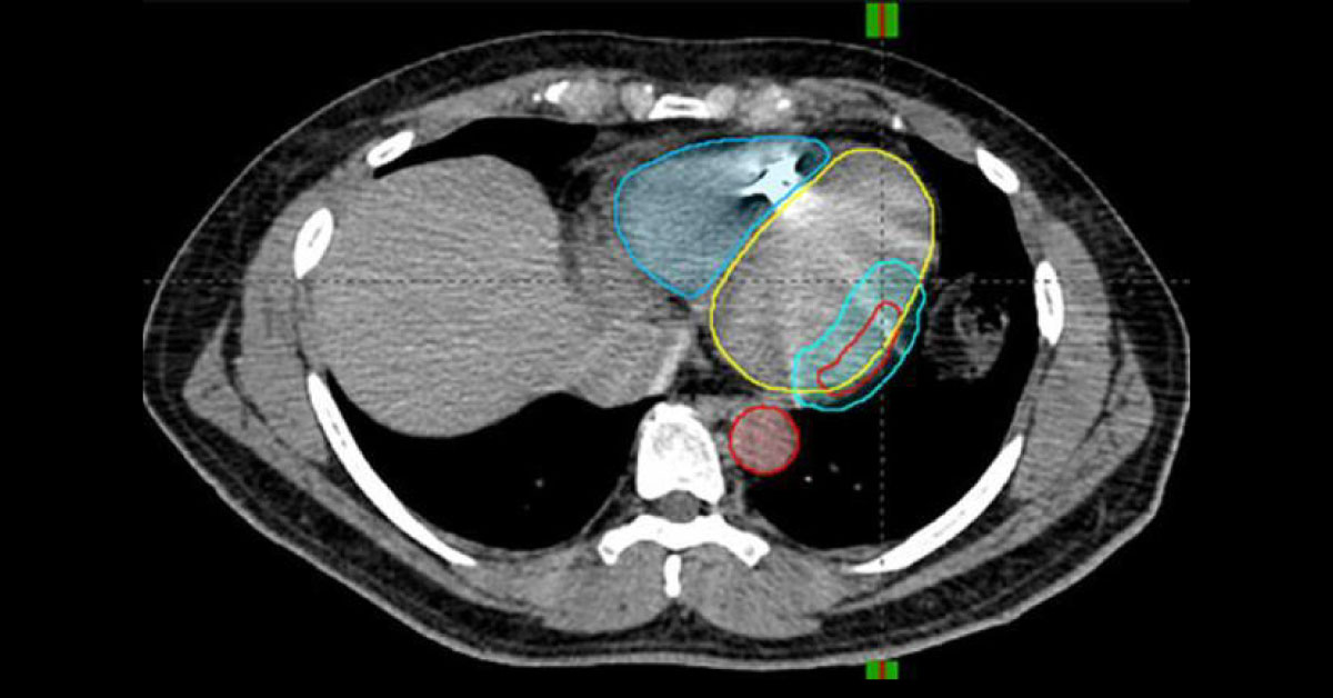Why some organ more vulnerable to cancer than others ?