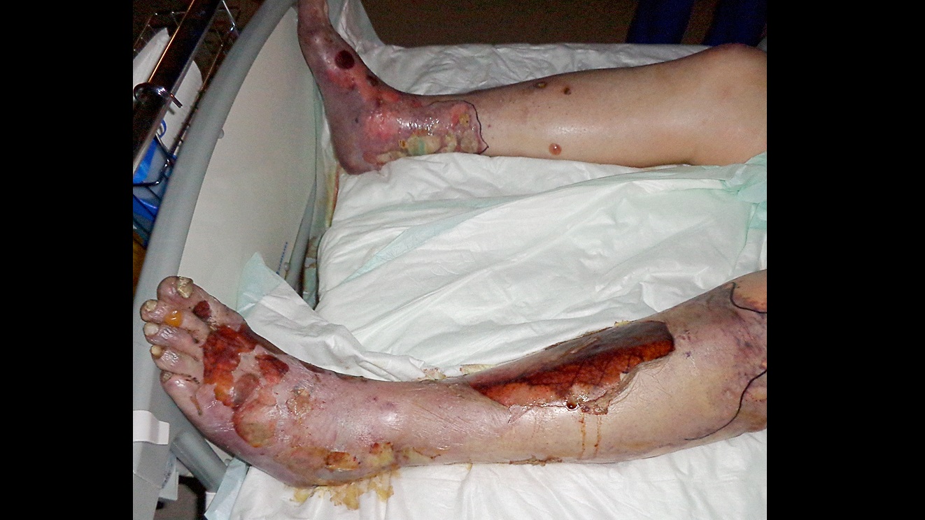 Toxic Epidermal Necrolysis, An Overview