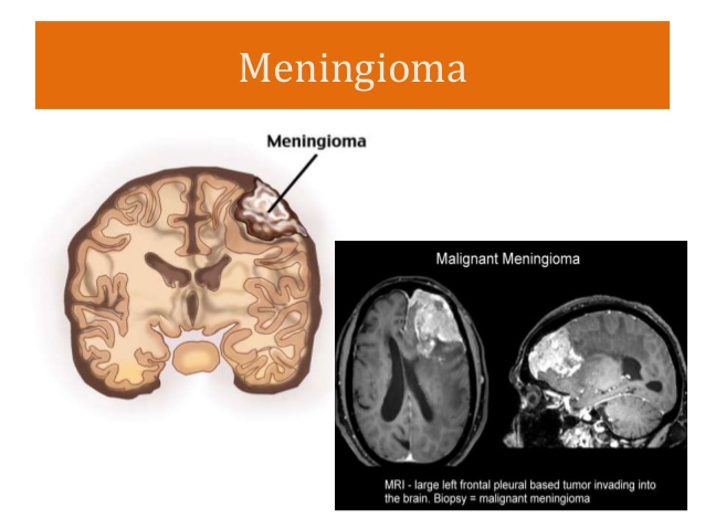 Brief Review On Ocular Manifestations Of Intra Cranial Space Occupying Lesions