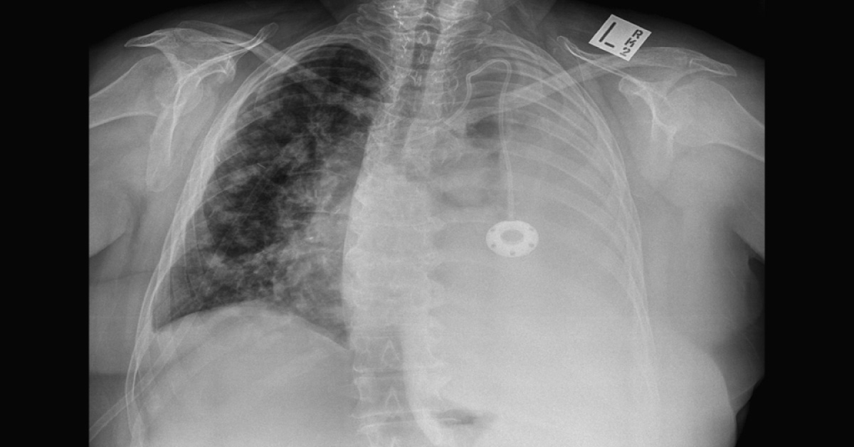 Breathlessness After Chemotherapy