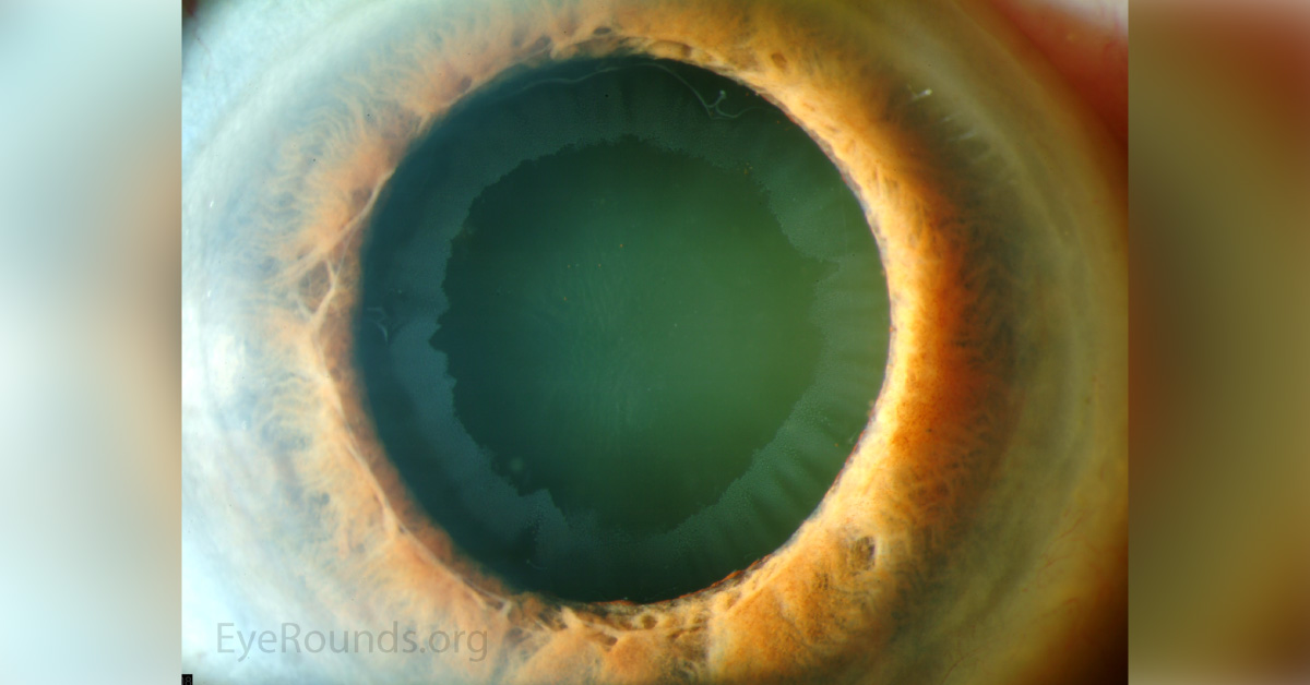 Obrief Review On Ocular And Systemic Pseudoexfoliation Syndrome