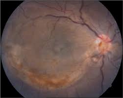 Ocular Manifestations Of Panhypopituitarism
