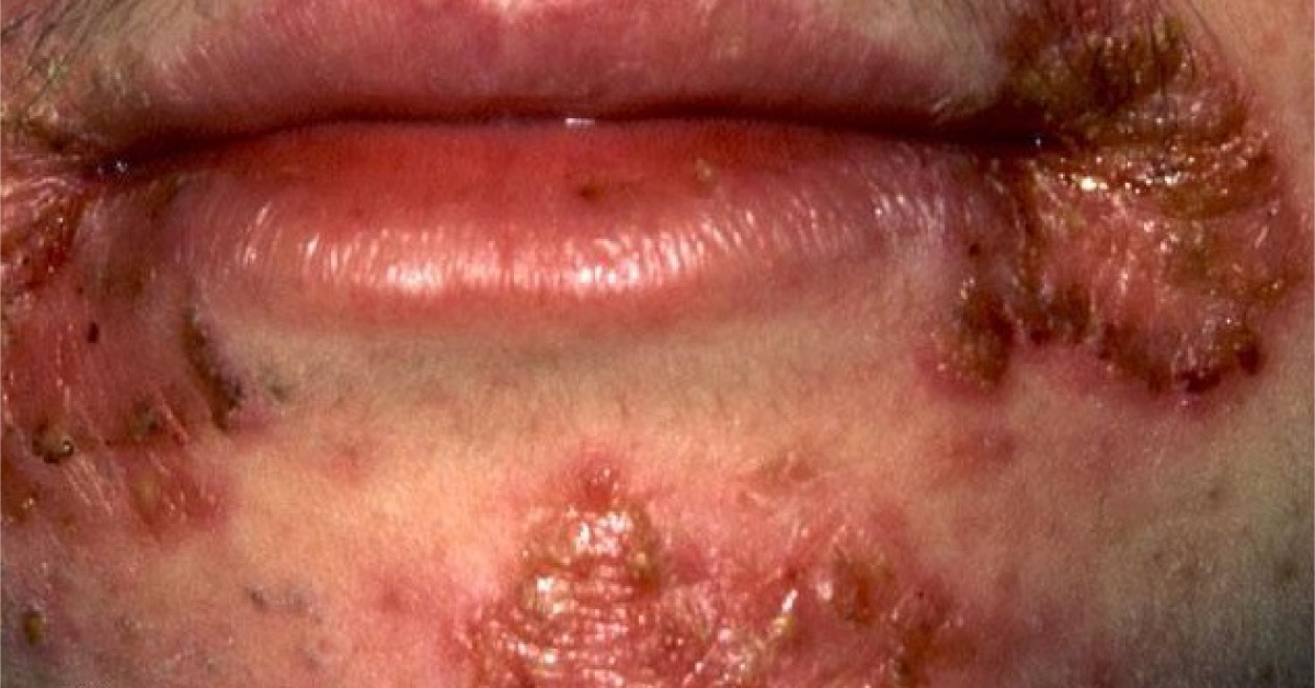 Identify This Dermatological Condition