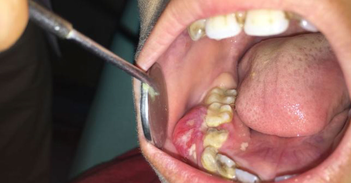 Oral Pathology, May Be Non Malignant