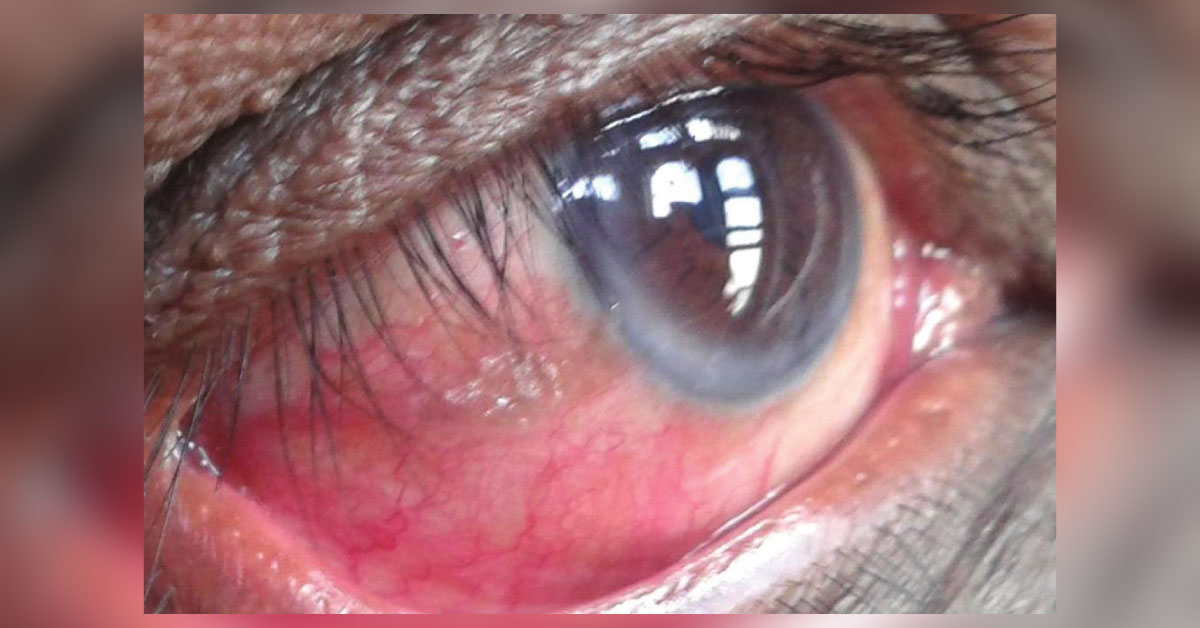 Ocular Manifestations Of Severe Protein Malnutrition