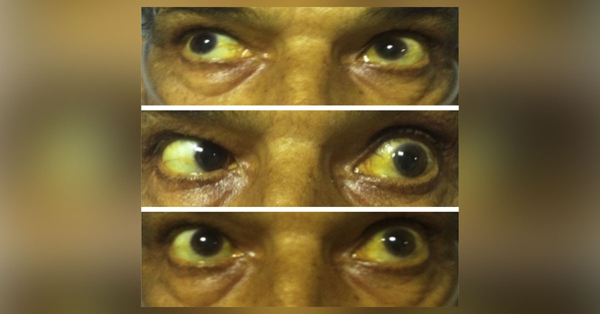 Brief Review On Ocular Manifestations Of Infectious Endocarditis