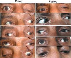 Bref Review On Ocular Manifestations Of Sphenoid Mucocele
