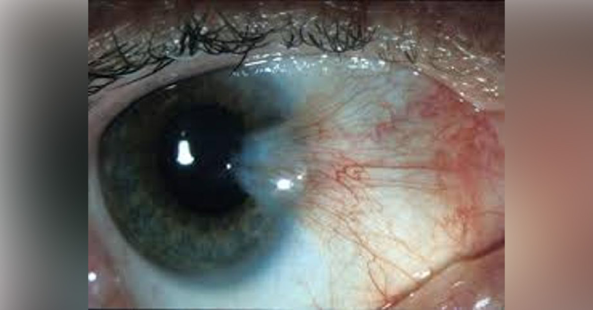 Brief Review On Surgical Modalities Of Pterygium