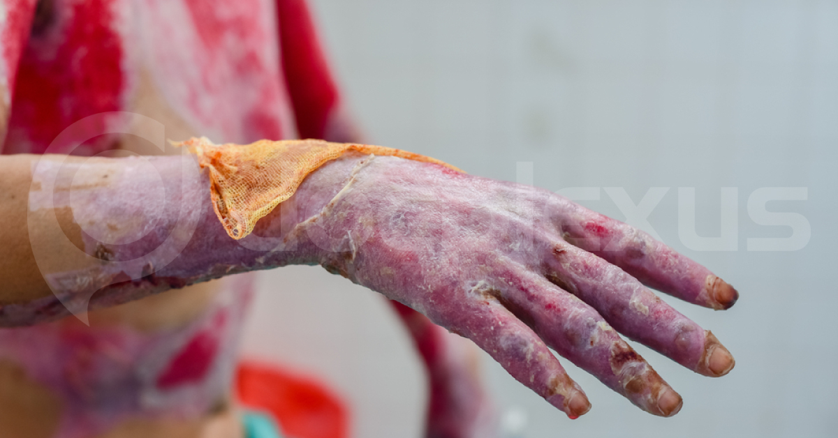 Emergency Treatment for Managing Major Burns