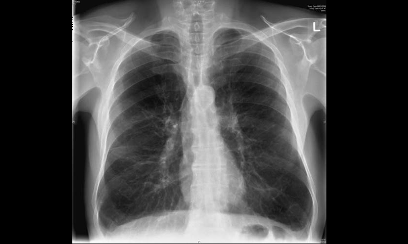 Cough And Breathlessness In An Elderly
