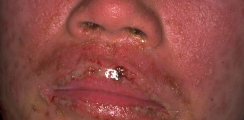 Steven Johnson Syndrome, Doctor’s Negligence?