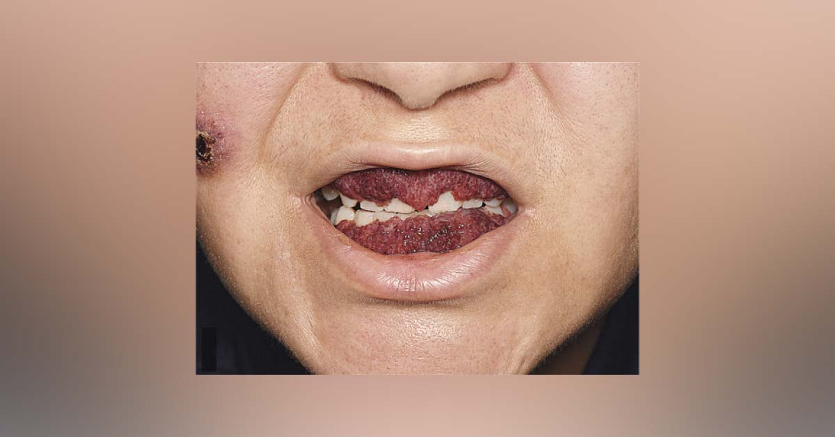 Strawberry Gingivitis