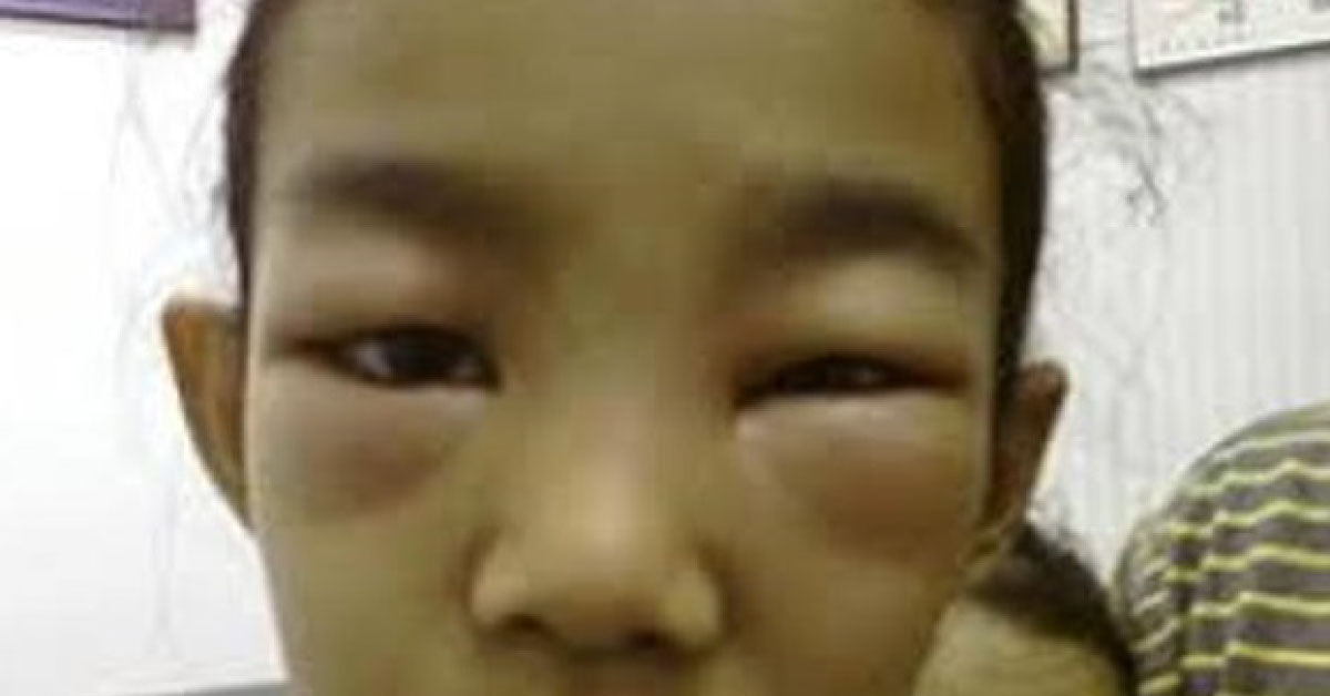 Ocular Manifestations Of Pediatric Patients With Nephrotic Syndrome