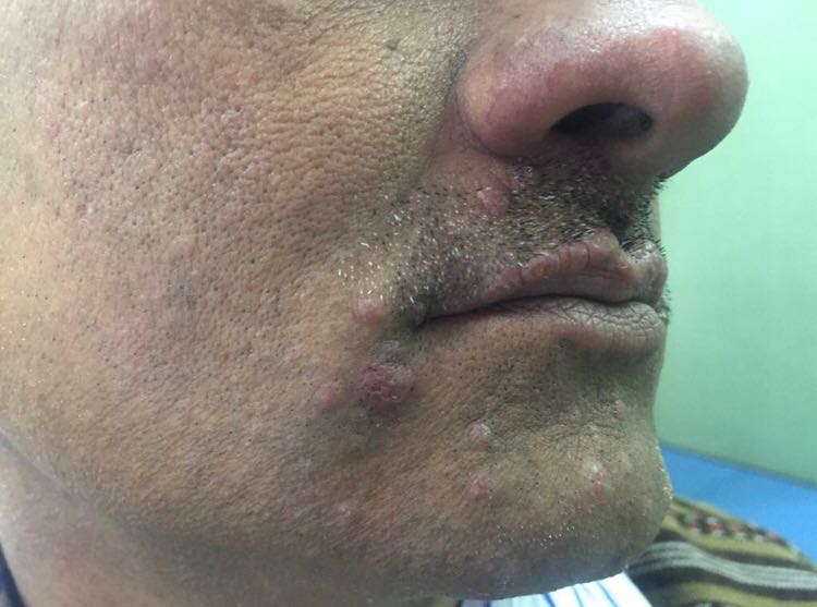 Differential Diagnosis For Asymptomatic Erythematous Papules On Face?