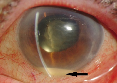 Brief Review On Ocular Complications Of Pyogenic Liver Abscess