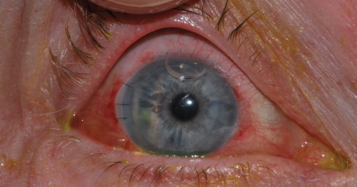 Brief Review On Ophthalmic Lesions In Rickets