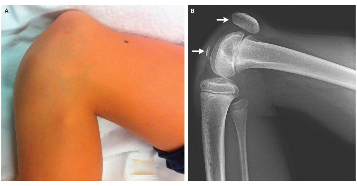 Is This a Case of Patellar Fracture?