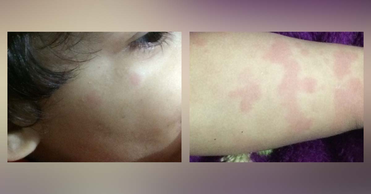 Itchy Skin Lesions In A Child