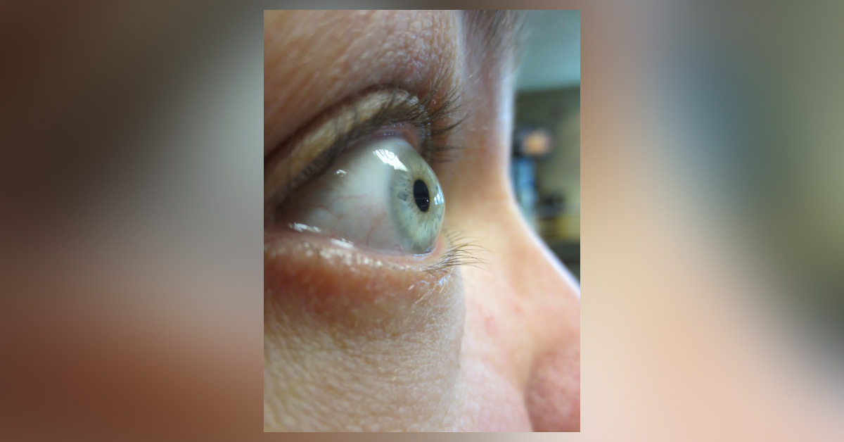 Ocular Manifestations Of Mitral Valve Prolapse Syndrome