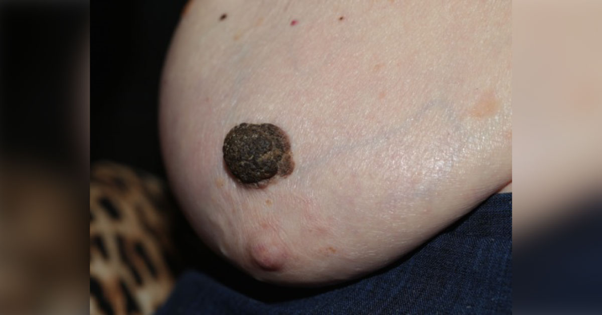 Abnormal Growth On Breast