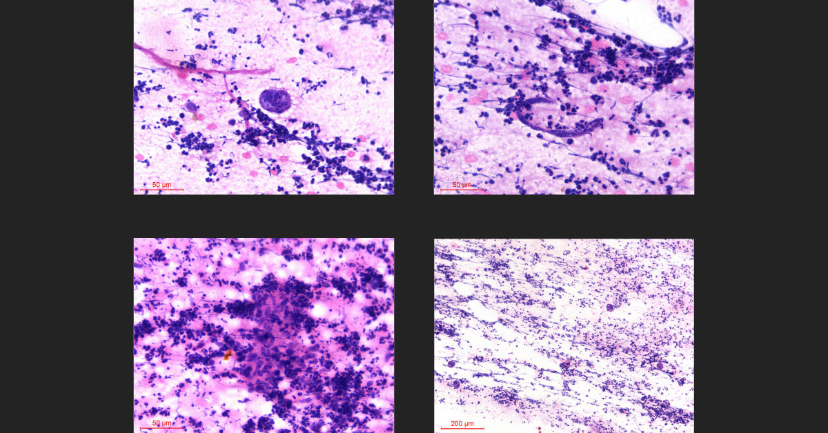 What's Your Diagnosis for This Young Boy with a Painless Swelling in His Neck?