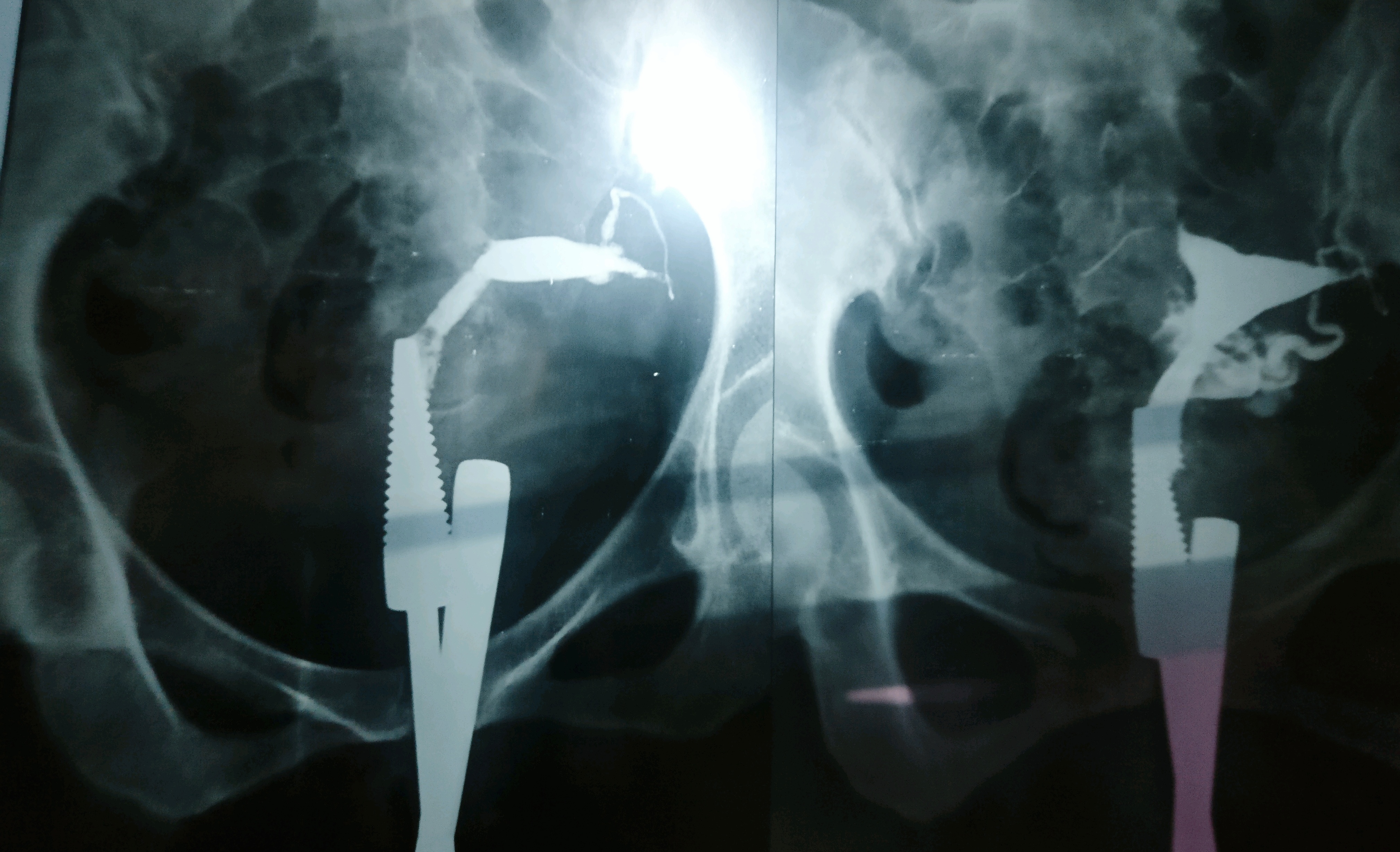 Fallopian Tube Blockage And Further Management 