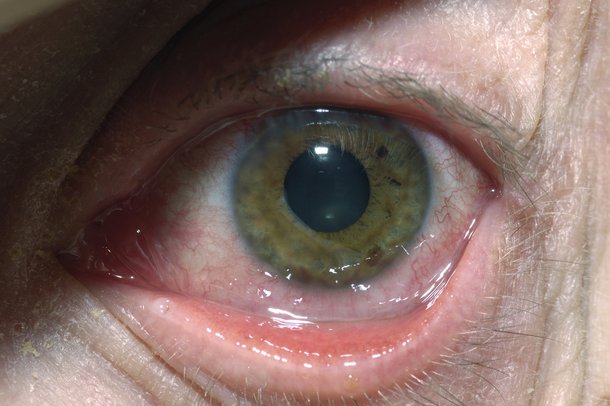 Ophthalmic Complications Of Chemotherapy