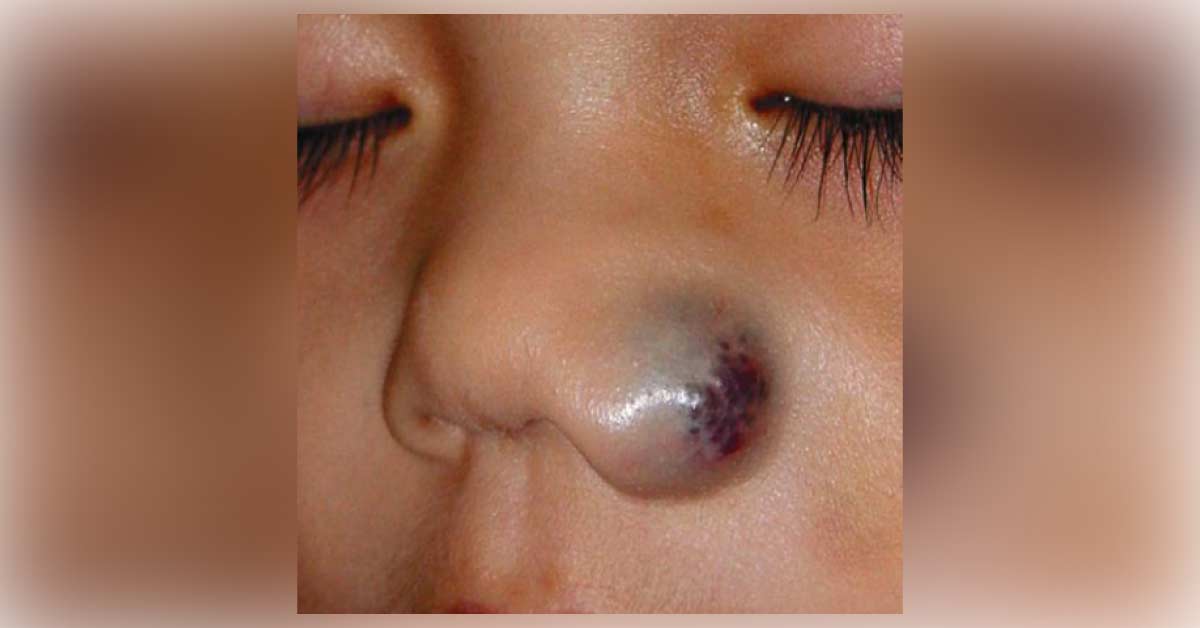 What is This Nasal Lesion?