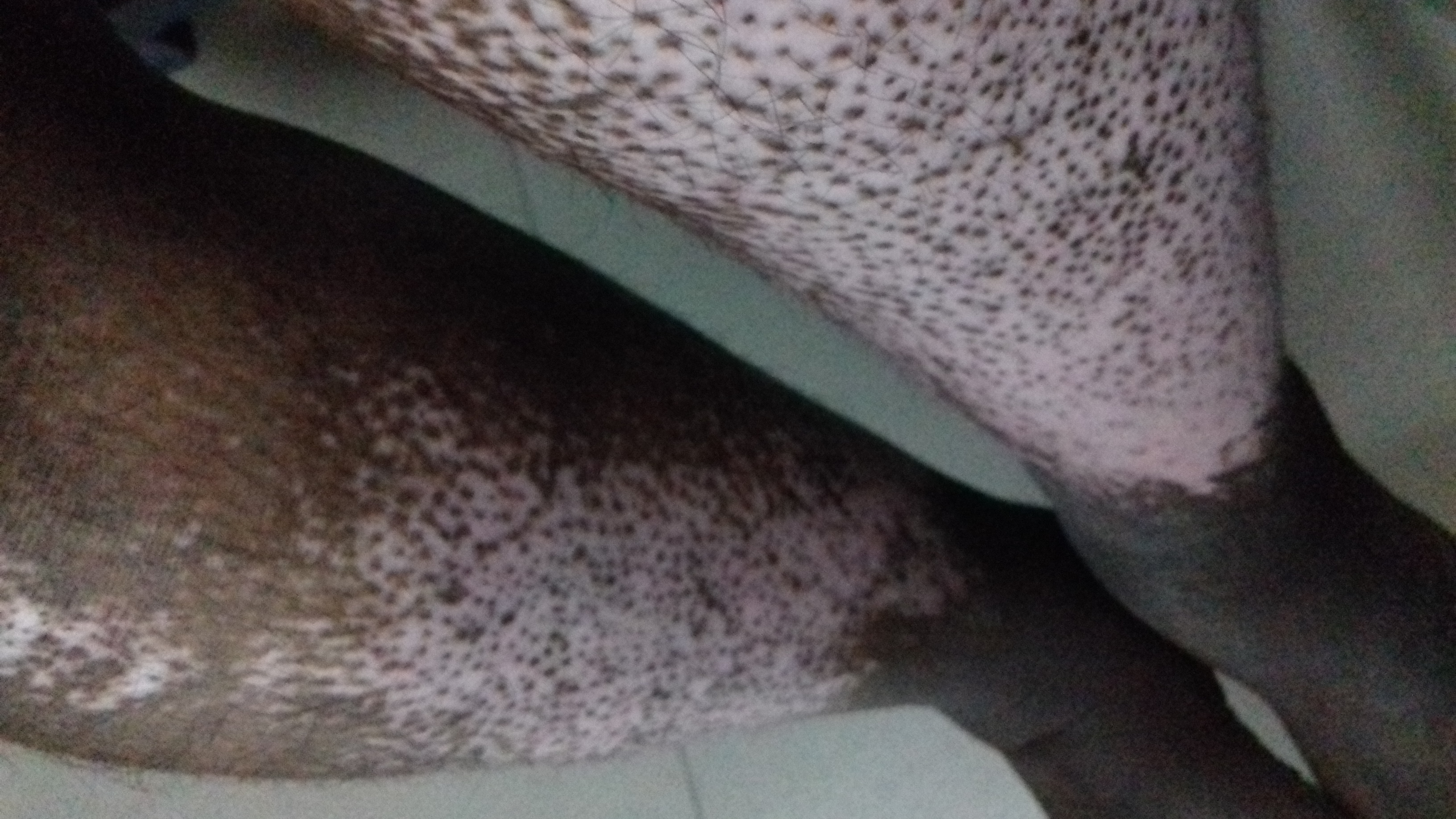 Diagnose This Neuro Dermatological Disorder