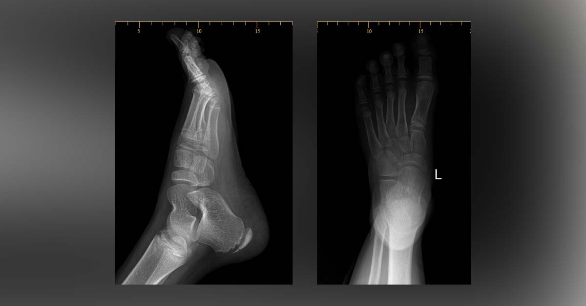 A Boy with Heel Pain
