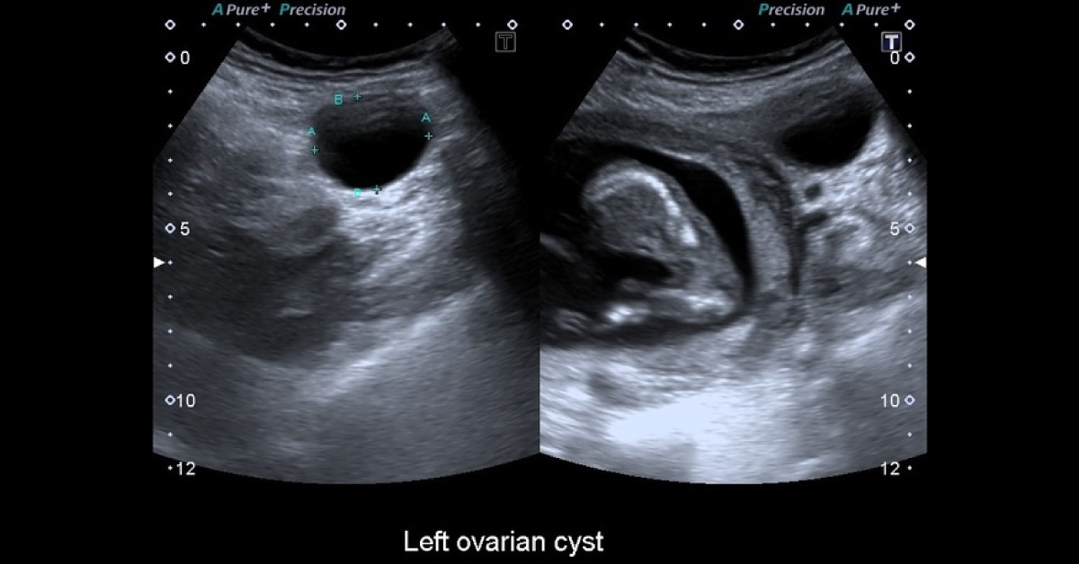 Female With Sever Right Lower Quadrant Pain