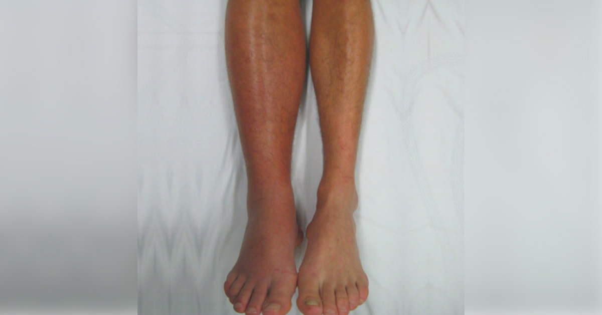 Swollen Right Leg