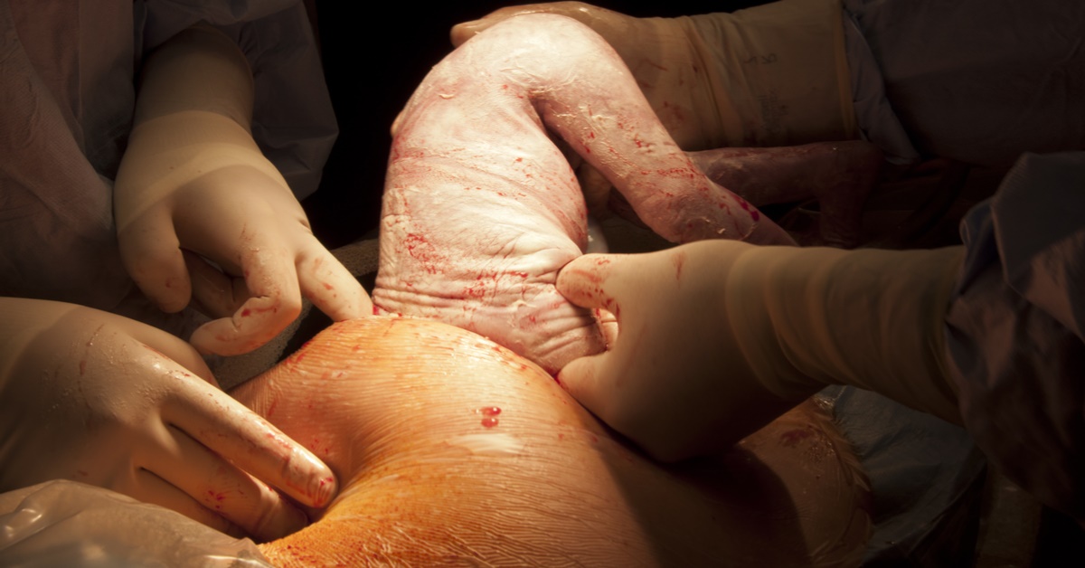 How To Reduce Future Pregnancy Complications Of Cesarean Delivery?