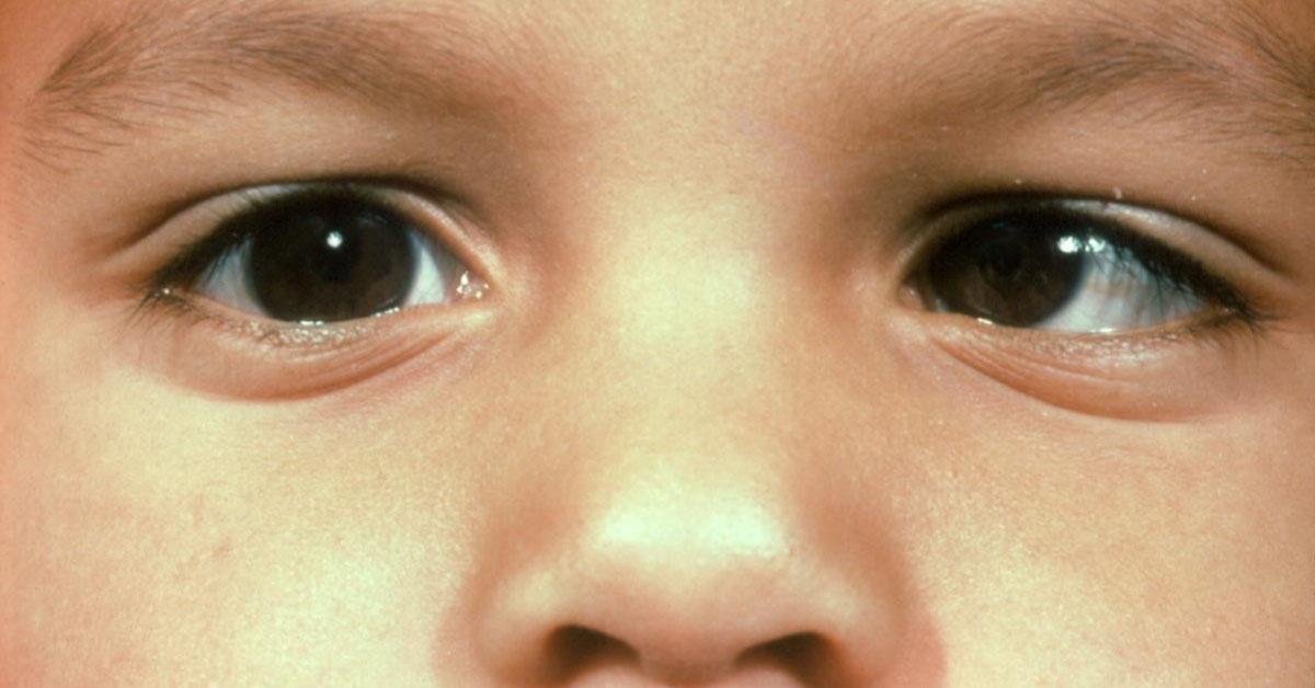 Brief Review Of Ocular Manifestations Of Cerebral Palsy