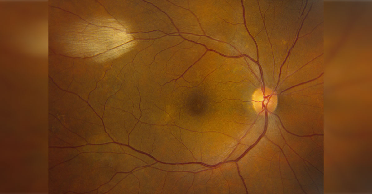 Brief Review On Associations Of Medullated Optic Nerve Fibers