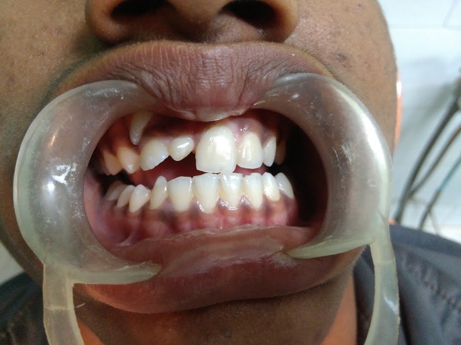 Ectpically Erupted Central Incisor