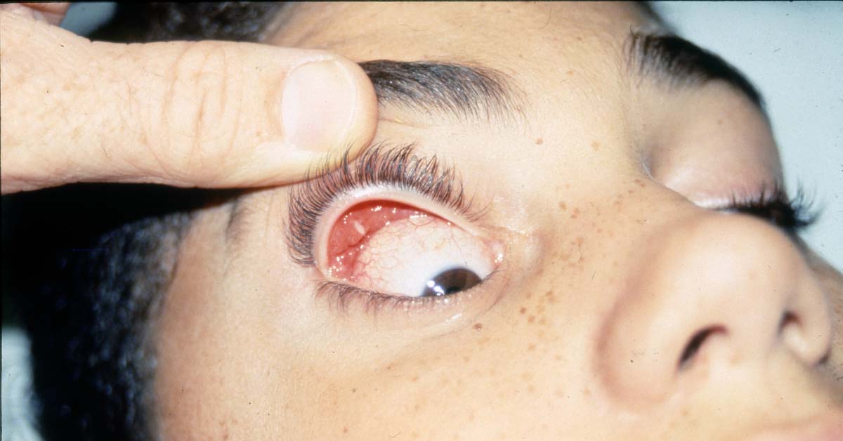 Brief On Ocular Manifestations Of Cat Scratch Disease