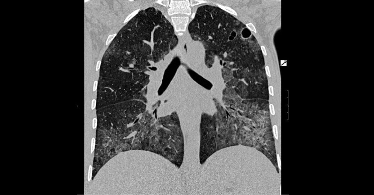 Male With Fever And Breathlessness