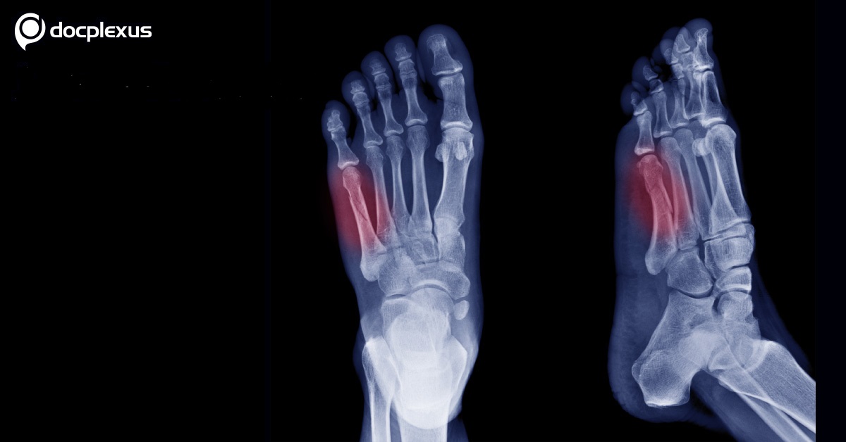 Fifth Metatarsal Fractures, Quick Surgical Management Guide